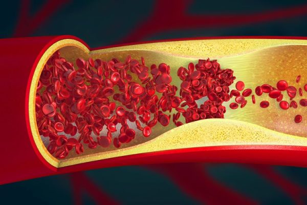5 Langkah-langkah Mencegah Trombosis dan Emboli 5 Langkah-langkah Mencegah Trombosis dan Emboli