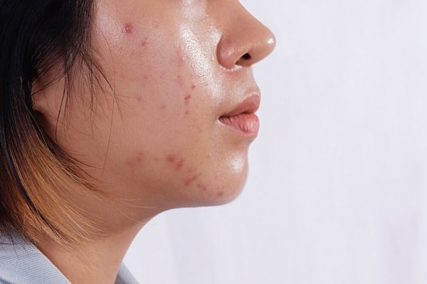 7 Tips Mengatasi Acne untuk Kulit Berminyak
