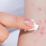 10 Cara Mengatasi Gatal Alergi Secara Alami