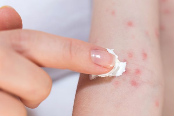 10 Cara Mengatasi Gatal Alergi Secara Alami