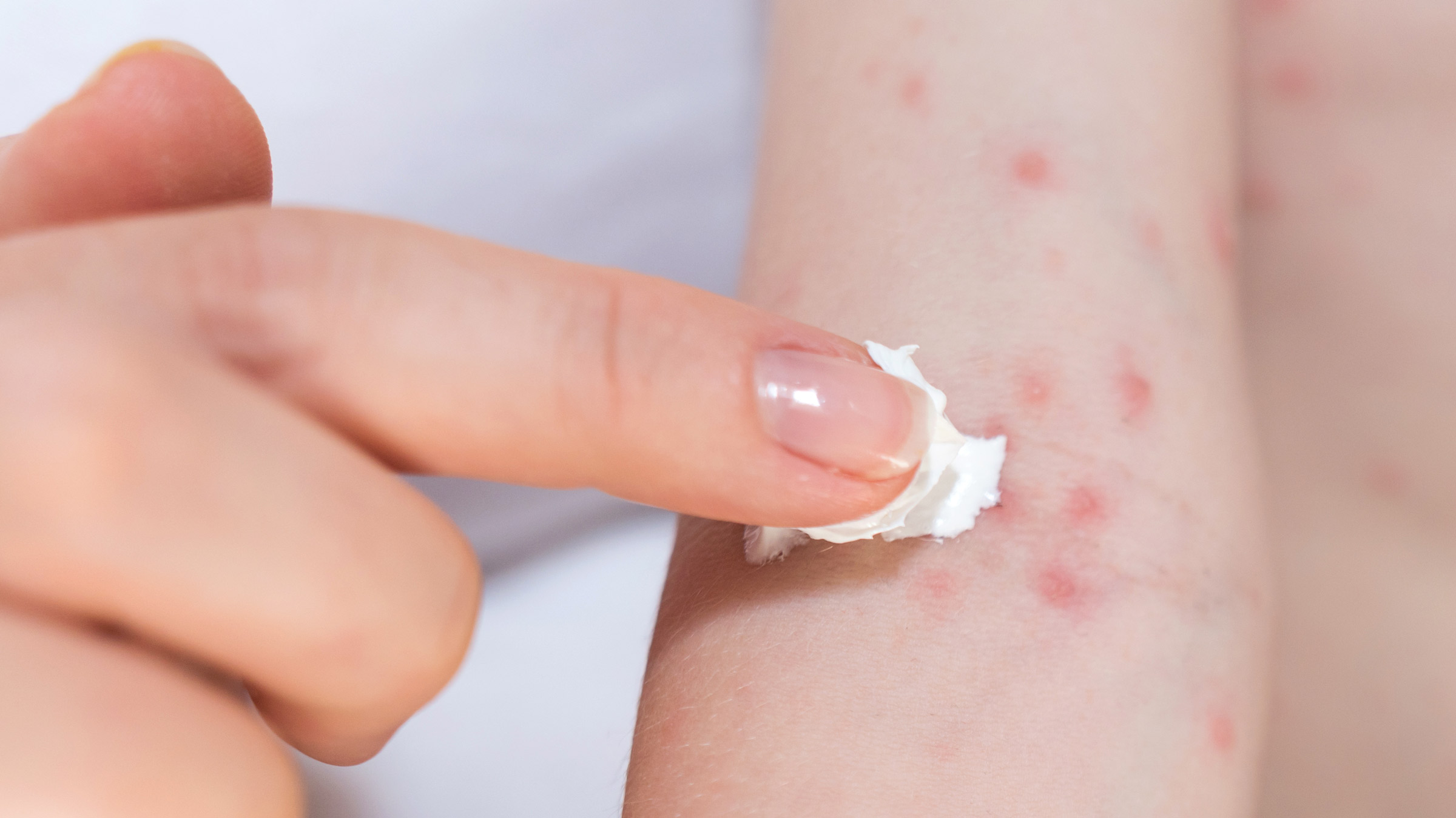 10 Cara Mengatasi Gatal Alergi Secara Alami