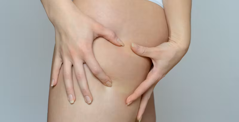 10 Mitos dan Fakta tentang Lemak di Paha