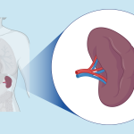 5 Cara Memelihara Limpa Bagi Penderita Anemia