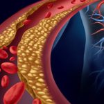 7 Langkah Menurunkan Risiko Aterosklerosis