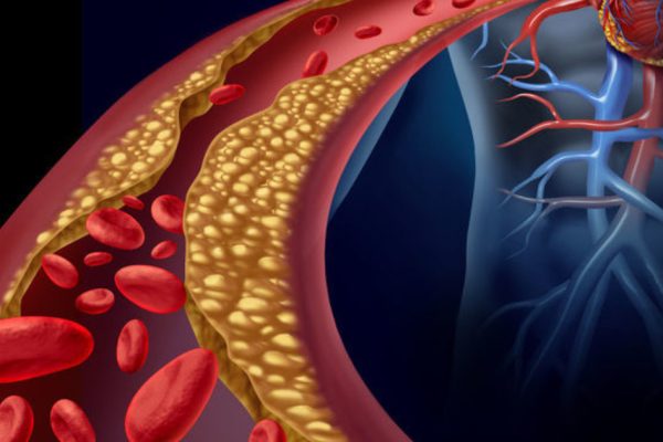 7 Langkah Menurunkan Risiko Aterosklerosis 7 Langkah Menurunkan Risiko Aterosklerosis