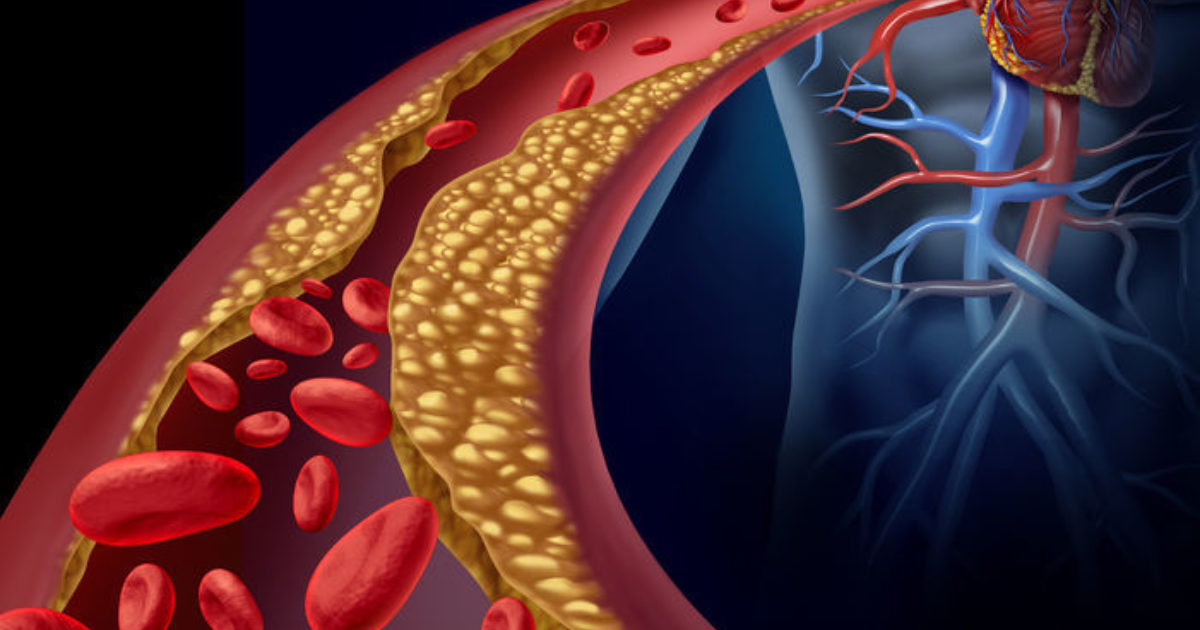 7 Langkah Menurunkan Risiko Aterosklerosis