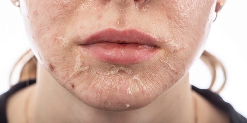 5 Cara Mengatasi Kulit Mengelupas dengan Bahan Alami